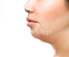 Hút Mỡ Nọng Cằm – Giảm Mỡ Nhanh, Tạo Vline Thanh Tú | Đấu Giá Thegioikhoedep.com