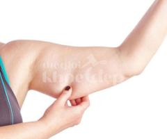 Đấu Giá Hút Mỡ Bắp Tay – Giảm Béo Nhanh & An Toàn | TheGioiKhoeDep.com