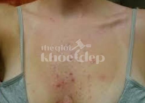 Trị Mụn Ngực – Da Sạch, Không Thâm, Tự Tin Mặc Đầm | Thegioikhoedep.com