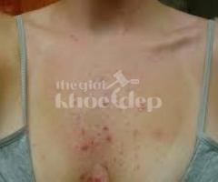 Trị Mụn Ngực – Da Sạch, Không Thâm, Tự Tin Mặc Đầm | Thegioikhoedep.com