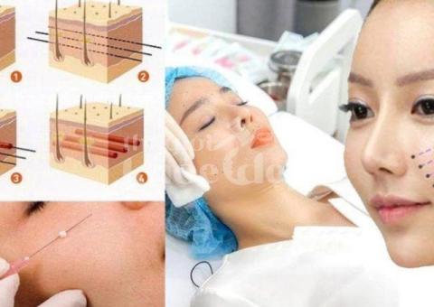 Căng chỉ nâng cơ – Giải pháp trẻ hóa da hiệu quả, an toàn, không phẫu thuật