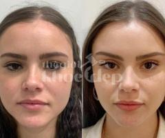 Căng chỉ nâng cơ cho phụ nữ sau sinh – Giải pháp trẻ hóa an toàn, hiệu quả