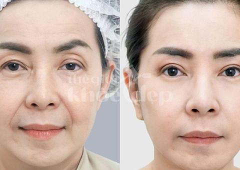 Căng chỉ nâng cơ cho dân văn phòng – Giải pháp trẻ hóa da hiệu quả