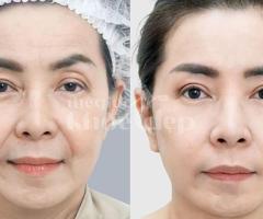 Căng chỉ nâng cơ cho dân văn phòng – Giải pháp trẻ hóa da hiệu quả