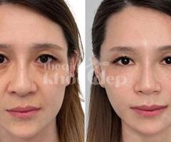 Căng chỉ nâng cơ tuổi 40 – Bí quyết trẻ hóa an toàn, hiệu quả