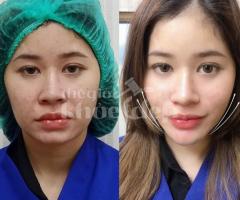 Căng chỉ V-line – Giải pháp tạo gương mặt thon gọn không dao kéo