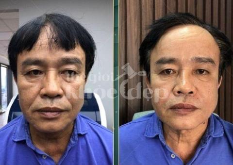 Căng chỉ nâng cơ cho nam giới – Giải pháp trẻ hóa an toàn