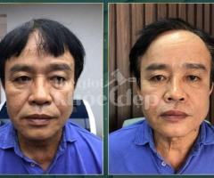 Căng chỉ nâng cơ cho nam giới – Giải pháp trẻ hóa an toàn