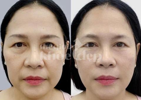 Căng chỉ nâng cơ tuổi 30+ – Chặn đứng lão hóa, giữ mãi nét thanh xuân