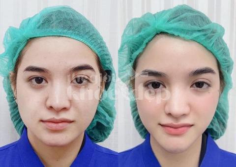 Căng chỉ nâng cơ vùng mắt – Xóa nhăn, hết quầng thâm, lấy lại ánh nhìn tươi trẻ