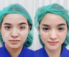 Căng chỉ nâng cơ vùng mắt – Xóa nhăn, hết quầng thâm, lấy lại ánh nhìn tươi trẻ
