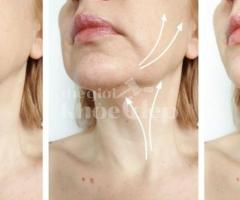 Căng chỉ nâng cơ vùng cổ – Giải pháp xóa nhăn, trẻ hóa toàn diện