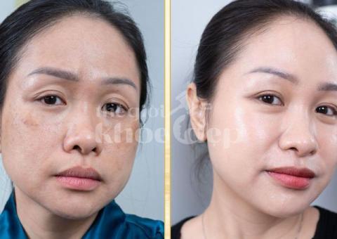 Trị Nám Hiệu Quả – Bí Quyết Phục Hồi Làn Da Sáng Mịn Tại Spa Uy Tín - 1/8