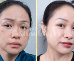 Trị Nám Hiệu Quả – Bí Quyết Phục Hồi Làn Da Sáng Mịn Tại Spa Uy Tín