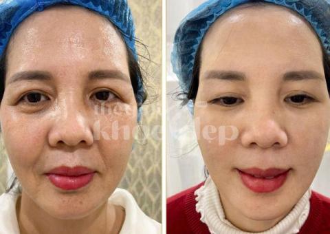 Trị Nám Hiệu Quả – Bí Quyết Phục Hồi Làn Da Sáng Mịn Tại Spa Uy Tín - 2/8
