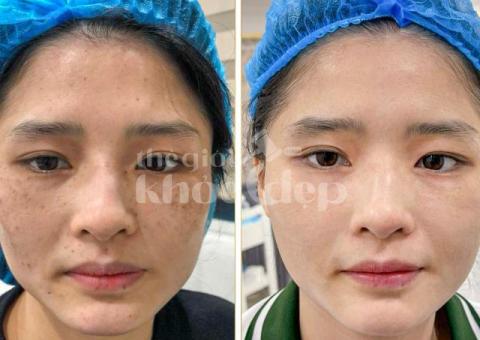 Trị Nám Hiệu Quả – Bí Quyết Phục Hồi Làn Da Sáng Mịn Tại Spa Uy Tín - 8/8