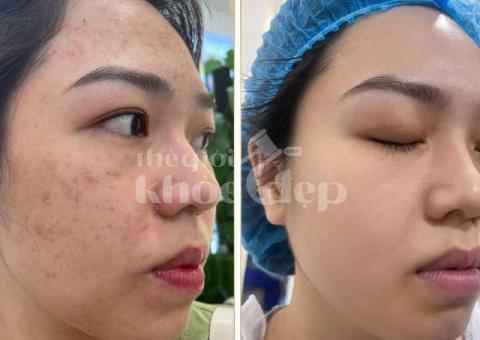 “Trán Không Còn Mụn – Da Mịn Sáng, Tự Tin Giao Tiếp!” - 1/8