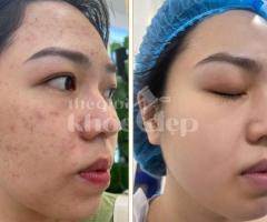 “Trán Không Còn Mụn – Da Mịn Sáng, Tự Tin Giao Tiếp!”