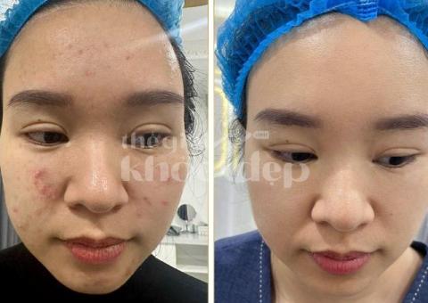 “Trán Không Còn Mụn – Da Mịn Sáng, Tự Tin Giao Tiếp!” - 2/8