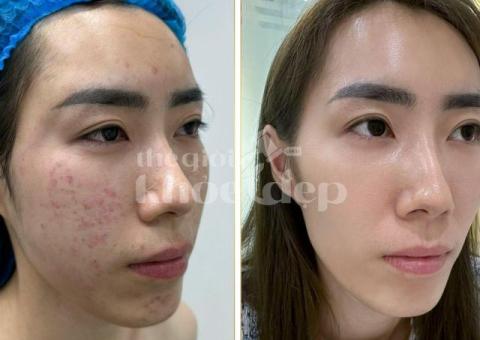 “Trán Không Còn Mụn – Da Mịn Sáng, Tự Tin Giao Tiếp!” - 6/8