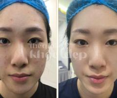 “Tuổi Dậy Thì Không Còn Ám Ảnh Vì Mụn – Bí Quyết Da Đẹp Ngay Từ Đầu!”