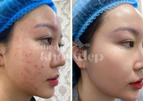 “Giải Pháp Vàng Cho Mụn Nội Tiết – Hết Sưng Viêm, Da Trở Lại Khỏe Đẹp!” - 1/3