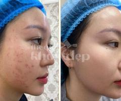 “Giải Pháp Vàng Cho Mụn Nội Tiết – Hết Sưng Viêm, Da Trở Lại Khỏe Đẹp!”