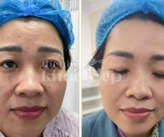 “Da Láng Mịn, Không Còn Lợn Cợn Mụn Ẩn – Bí Quyết Từ Chuyên Gia!”
