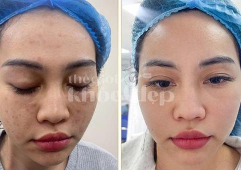 “Da Láng Mịn, Không Còn Lợn Cợn Mụn Ẩn – Bí Quyết Từ Chuyên Gia!” - 2/3