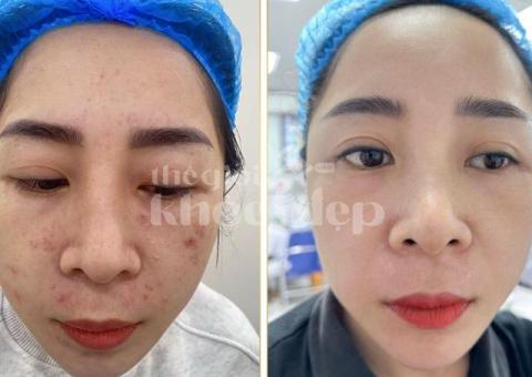 “Da Láng Mịn, Không Còn Lợn Cợn Mụn Ẩn – Bí Quyết Từ Chuyên Gia!” - 3/3