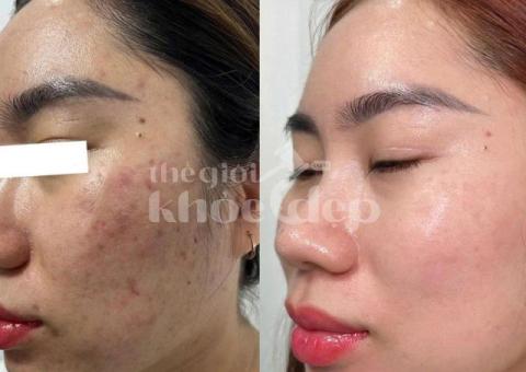 “Mụn Viêm, Mụn Mủ Không Còn Làm Bạn Đau Đớn & Mất Tự Tin!” - 1/3