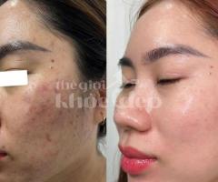 “Mụn Viêm, Mụn Mủ Không Còn Làm Bạn Đau Đớn & Mất Tự Tin!”