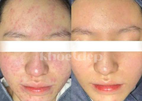 “Mụn Viêm, Mụn Mủ Không Còn Làm Bạn Đau Đớn & Mất Tự Tin!” - 2/3