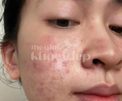 “Tạm Biệt Mụn Đầu Đen – Da Sáng Láng, Không Lỗ Chân Lông To!”