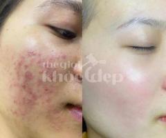 “Mụn Không Còn Là Nỗi Lo – Làn Da Sạch Sáng Chỉ Sau 1 Liệu Trình!”
