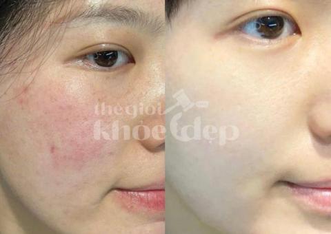 “Mụn Không Còn Là Nỗi Lo – Làn Da Sạch Sáng Chỉ Sau 1 Liệu Trình!” - 2/3