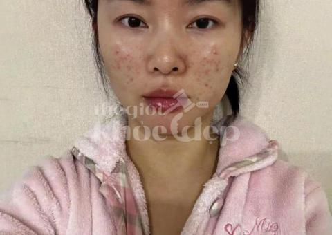 Mụn đầu đen đáng ghét khiến da sần sùi – Công nghệ chuyên sâu giúp da sáng mịn chỉ sau liệu trình! - 1/4