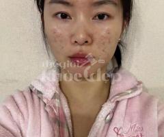 Mụn đầu đen đáng ghét khiến da sần sùi – Công nghệ chuyên sâu giúp da sáng mịn chỉ sau liệu trình!