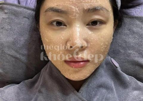 Mụn đầu đen đáng ghét khiến da sần sùi – Công nghệ chuyên sâu giúp da sáng mịn chỉ sau liệu trình! - 2/4