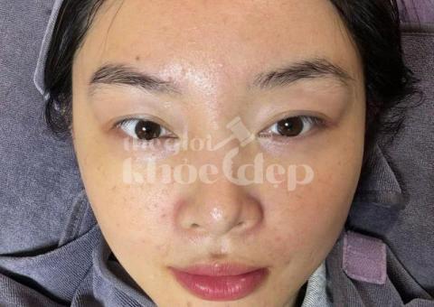 Mụn đầu đen đáng ghét khiến da sần sùi – Công nghệ chuyên sâu giúp da sáng mịn chỉ sau liệu trình! - 3/4