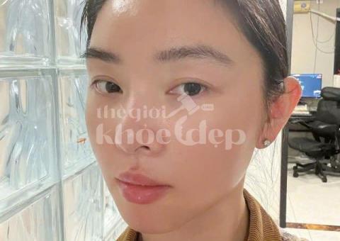 Mụn đầu đen đáng ghét khiến da sần sùi – Công nghệ chuyên sâu giúp da sáng mịn chỉ sau liệu trình! - 4/4