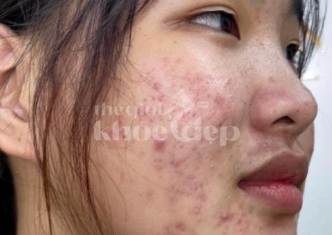 Mụn bọc, mụn mủ sưng đau – Công nghệ tiên tiến giúp xẹp mụn nhanh, ngừa sẹo triệt để! - 1/3