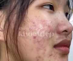 Mụn bọc, mụn mủ sưng đau – Công nghệ tiên tiến giúp xẹp mụn nhanh, ngừa sẹo triệt để!