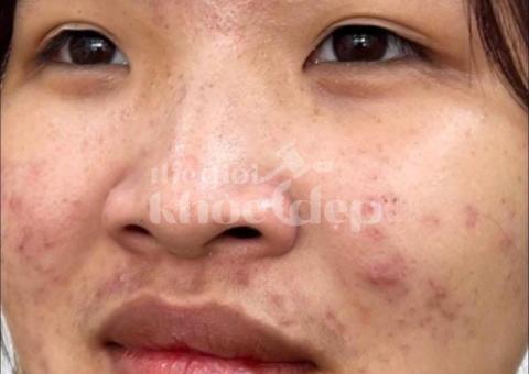 Mụn bọc, mụn mủ sưng đau – Công nghệ tiên tiến giúp xẹp mụn nhanh, ngừa sẹo triệt để! - 2/3