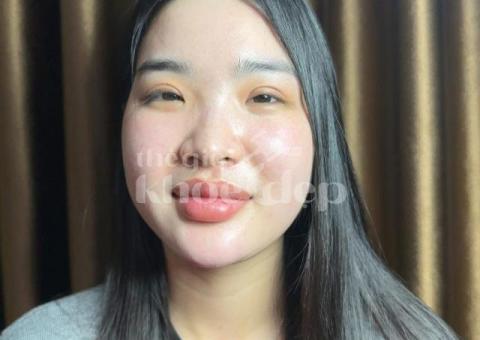 Mụn bọc, mụn mủ sưng đau – Công nghệ tiên tiến giúp xẹp mụn nhanh, ngừa sẹo triệt để! - 3/3