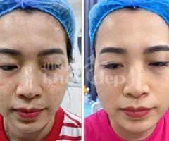 Trị sẹo rỗ nhanh chóng | Laser RF vi điểm – Da mịn săn chắc