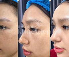 Trị Nám Peel Da Y Khoa – Làm Mờ Nám, Tái Tạo Làn Da Sáng Khỏe