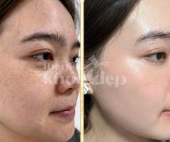 Trị Nám Do Nội Tiết – Cân Bằng Hormone, Da Sáng Mịn Tự Nhiên
