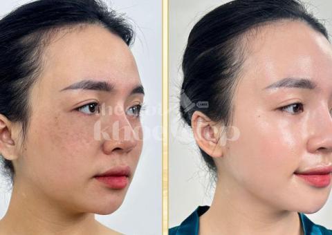 Trị Nám Do Nội Tiết – Cân Bằng Hormone, Da Sáng Mịn Tự Nhiên - 2/3