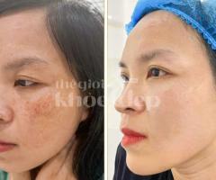 Trị Nám Tàn Nhang – Giải Pháp Kết Hợp Peel Da & Laser Chuẩn Y Khoa
